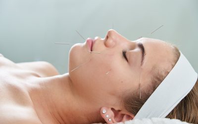What Clinical Methods Define Effective Acupuncture For Anxiety In Burbank, CA